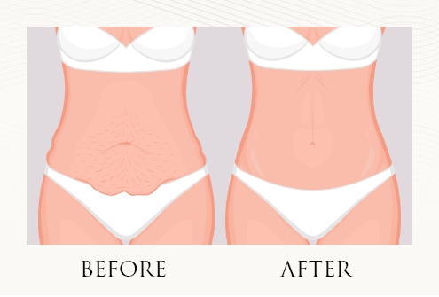 Before and after illustration of drainless tummy tuck procedure
