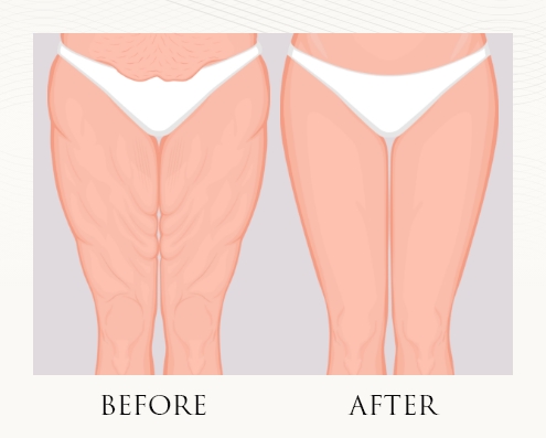 Before and after illustration of lower body lift treatment